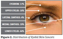 figure2_eyelidcancer